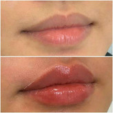 حجم دهنده لب گابرینی🥹🩷👀